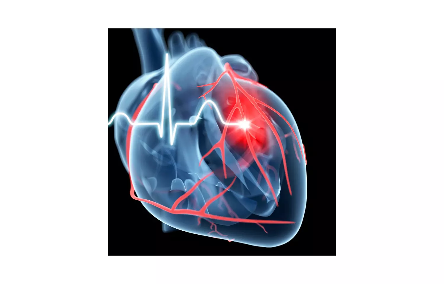 Dapagliflozin a new approach in the treating patients with heart failure: DAPA – HF Trial