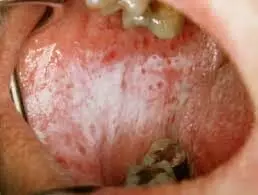 Certain salivary cytokines positively correlated with oral lichen planus severity: Study