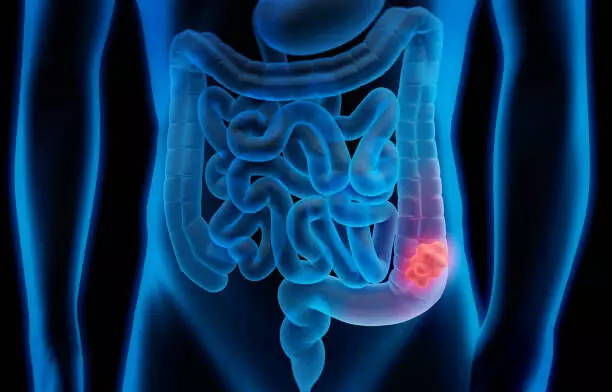 Periodontal disease associated with increased risk for sporadic colorectal cancer: Study