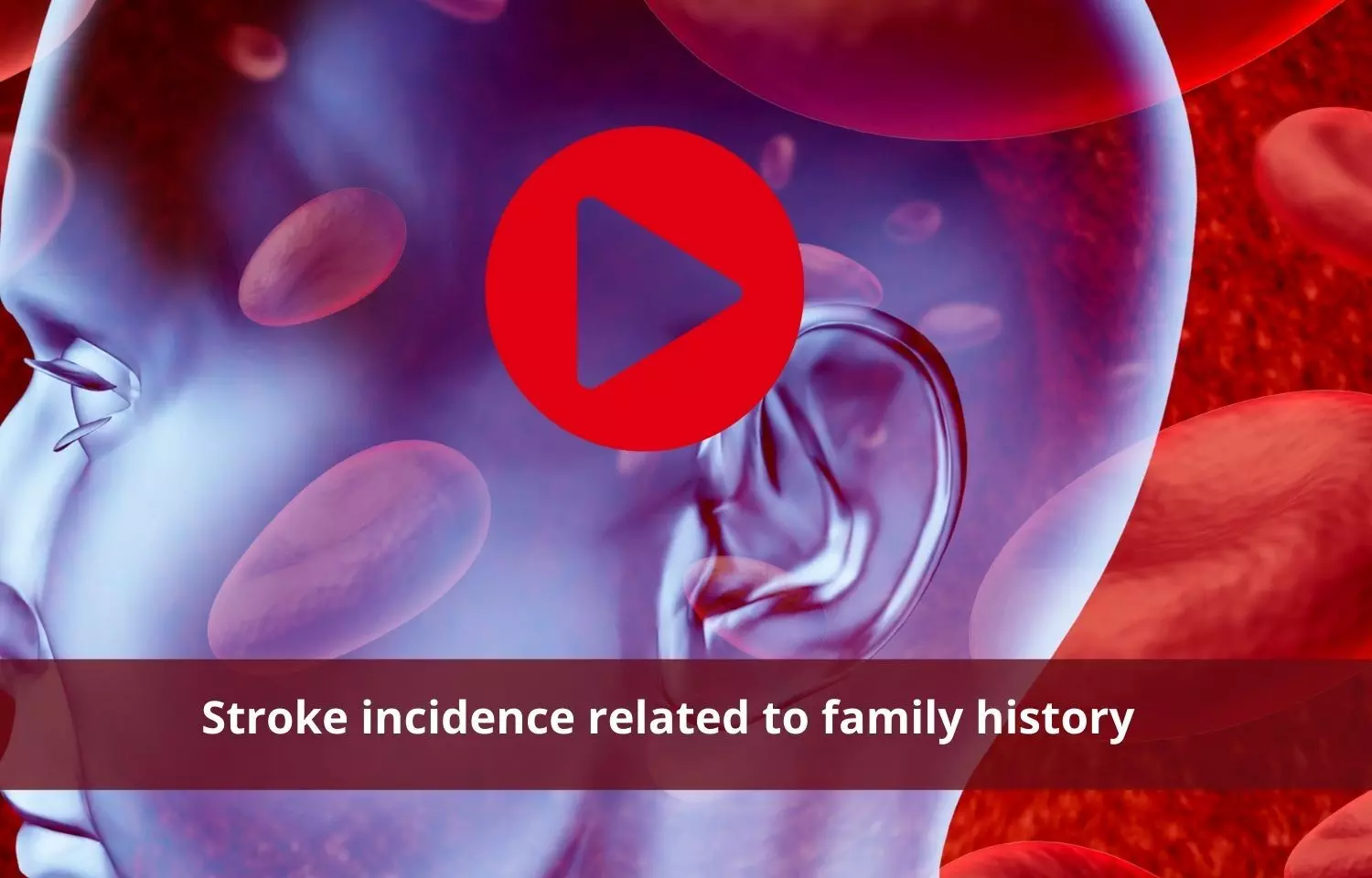 Stroke occurrence linked to familial history