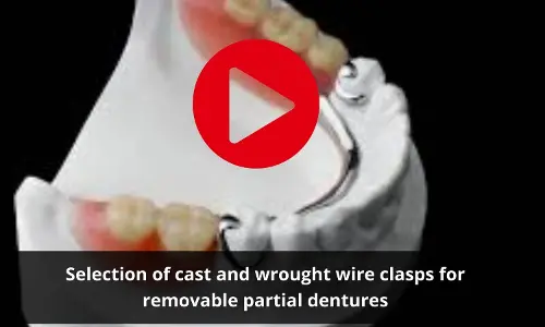 Cast and wrought wire clasps for removable partial dentures