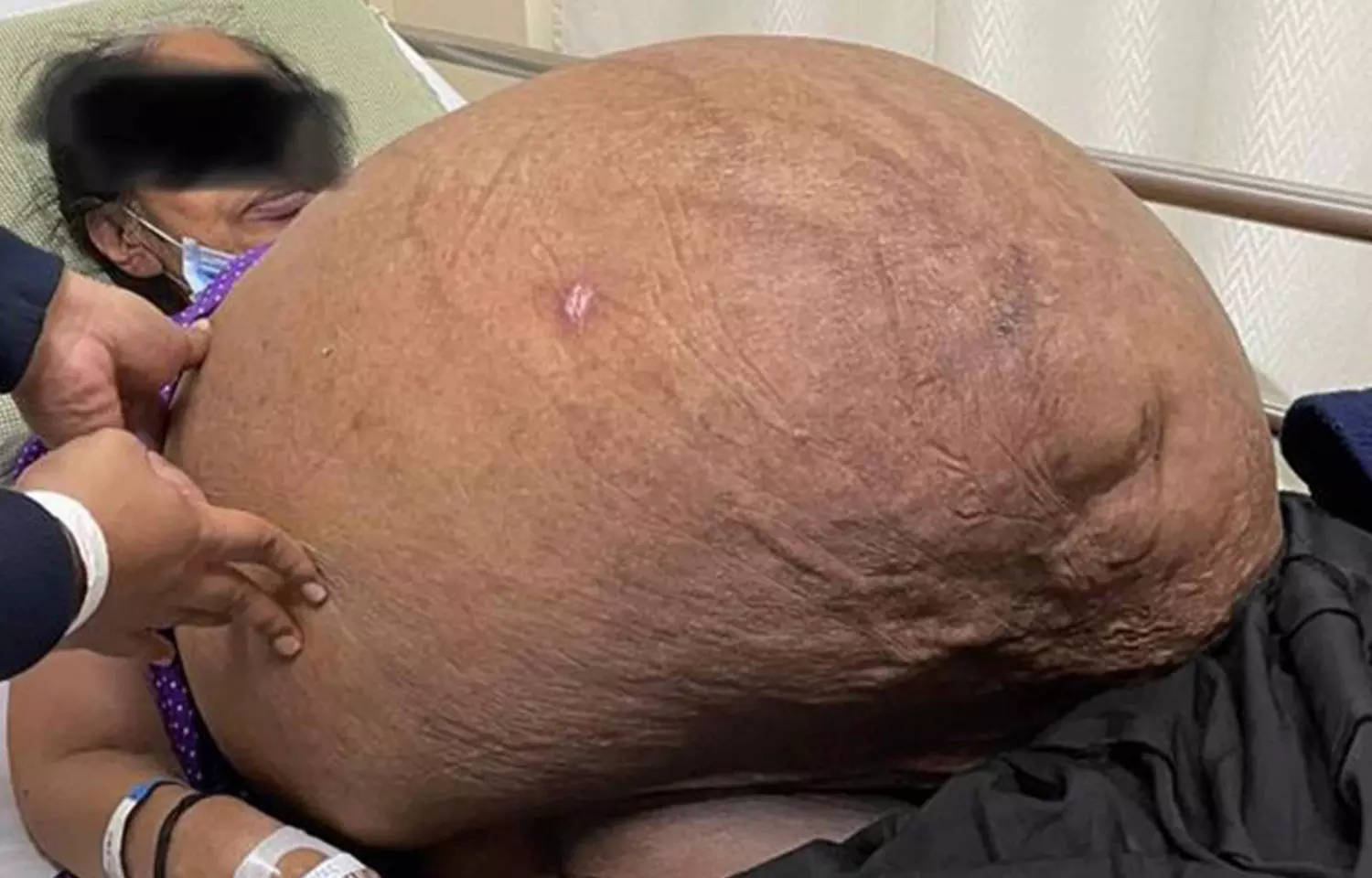 Massive non ovarian tumor of 47 Kg removed at Apollo Hospitals