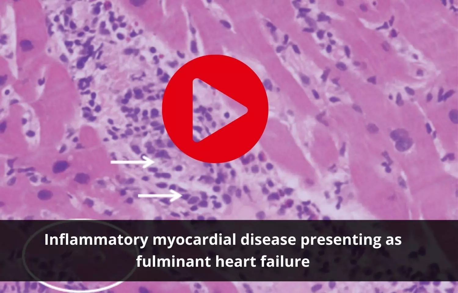 Inflammatory myocardial disease as symptom of fulminant heart failure