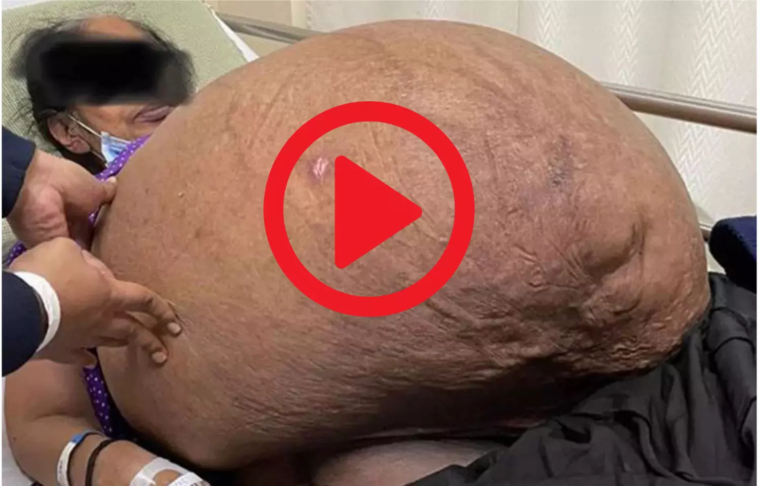 Doctors at Apollo Hospitals remove massive 47 kg non-ovarian tumour