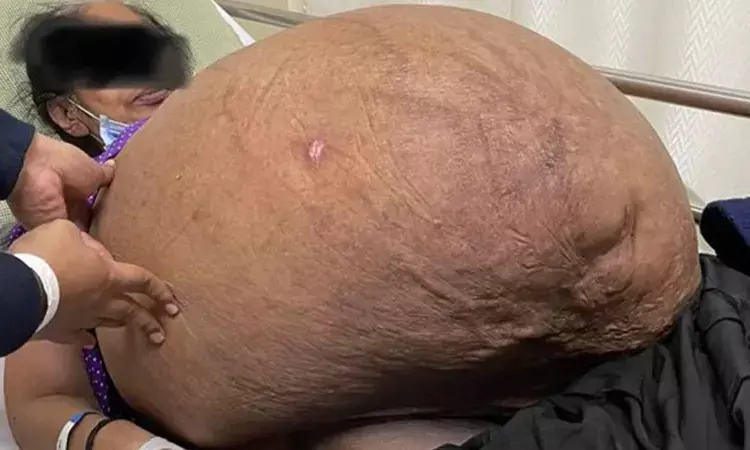 Massive non ovarian tumor of 47 Kg removed at Apollo Hospitals