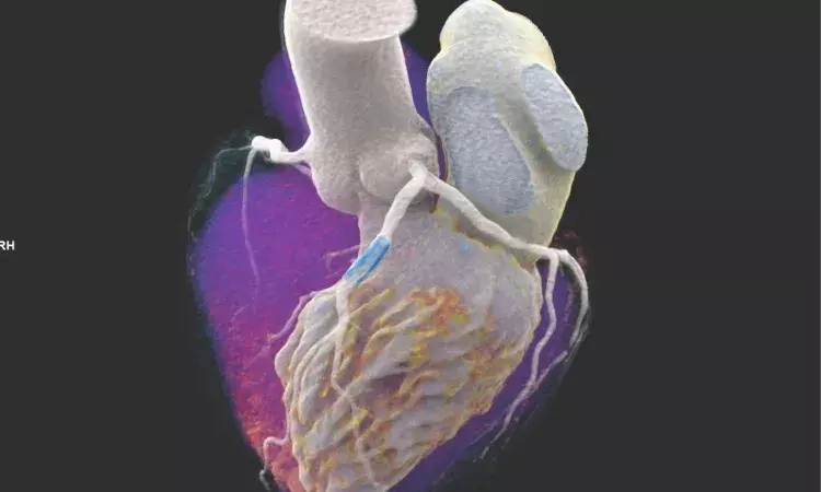 Photon-counting CT system promising for coronary artery disease imaging, study finds
