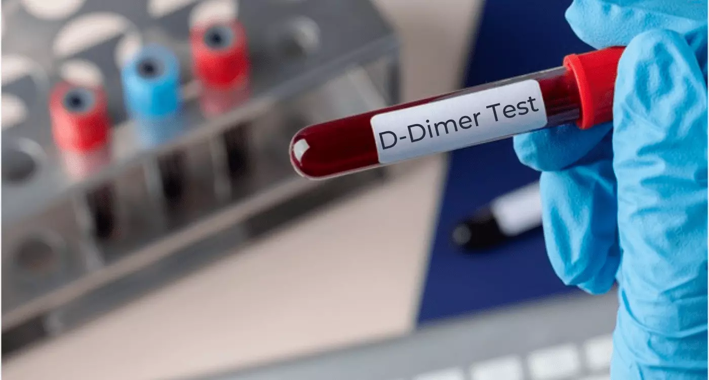 Clinical Pretest Probability & D-dimer Combo Help Diagnose DVT Effectively