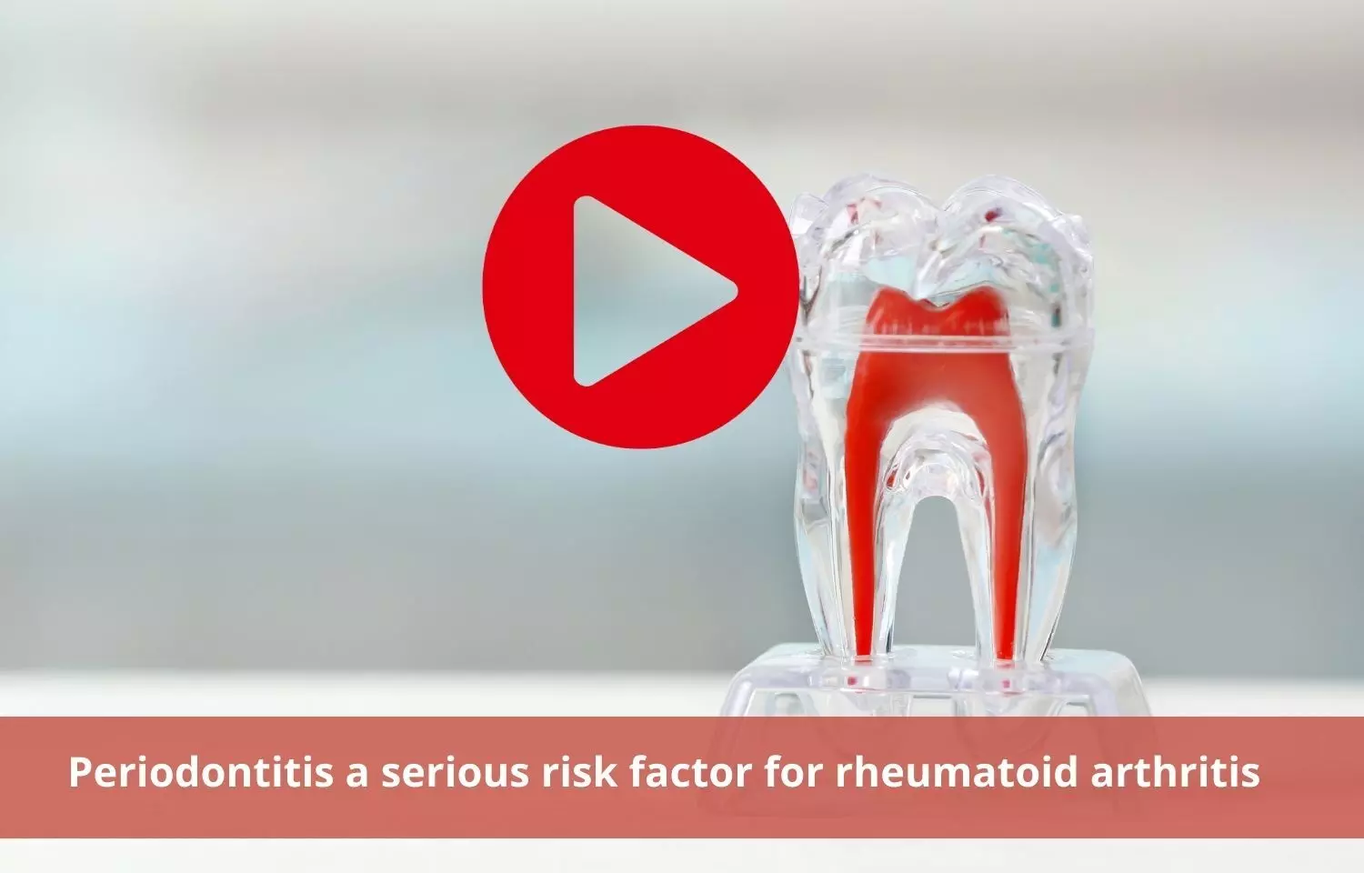 Periodontitis; Severe risk factor for rheumatoid arthritis