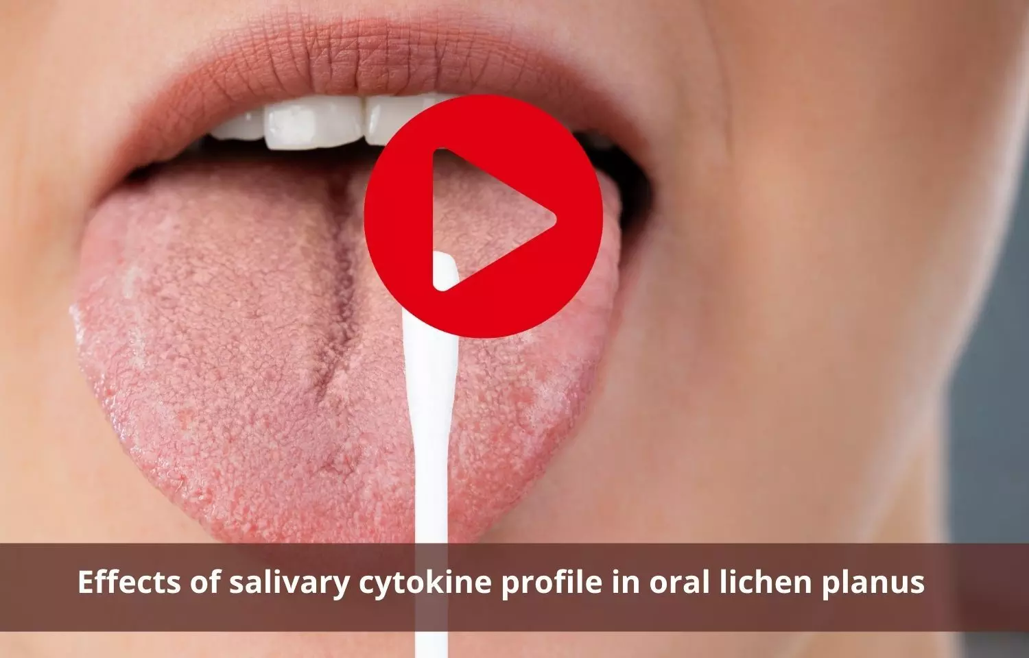 Role of salivary cytokine profile in oral lichen planus