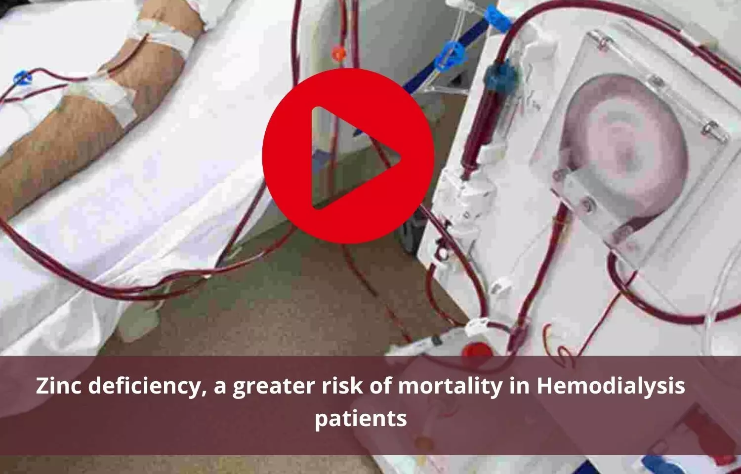 Zinc deficiency tied with higher risk of mortality in Hemodialysis patients