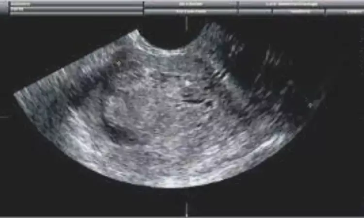 Transvaginal Ultrasound with bowel preparation alone might be best method for diagnosing rectosigmoid endometriosis: Study