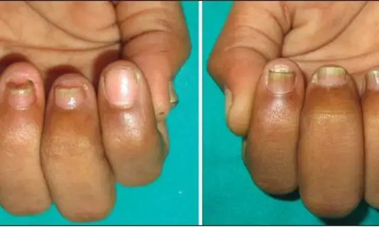 Topical Tretinoin effective in nail psoriasis