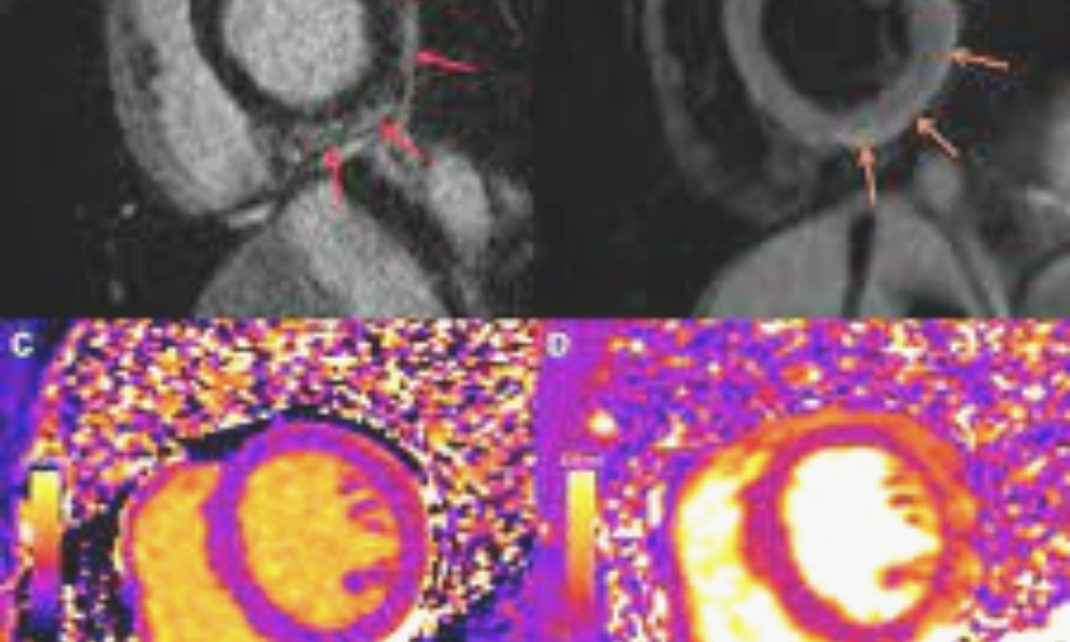 COVID 19 Vaccine Associated Myocarditis Milder Confirms Cardiac MRI   170963 Vaccineassociated Myocarditis 