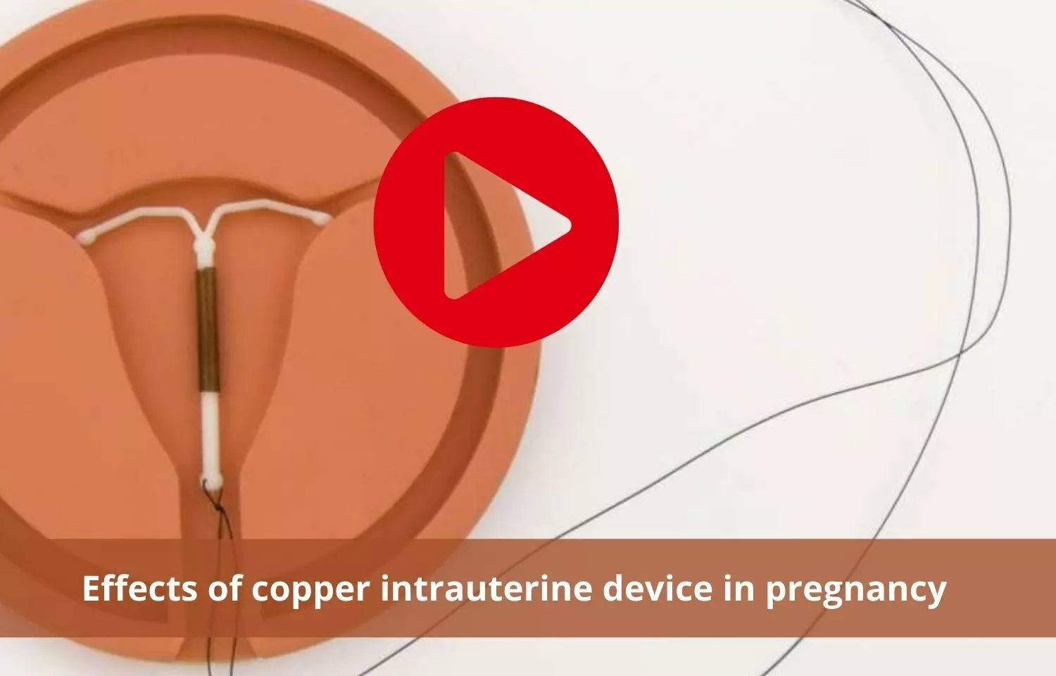 Copper interuterine devices in pregnancy and its effects