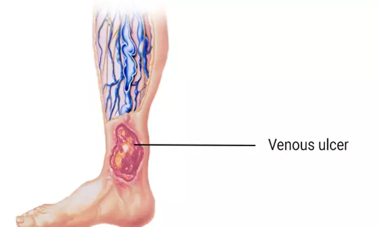 Platelet-rich plasma effective treatment option for venous ulcers: Study