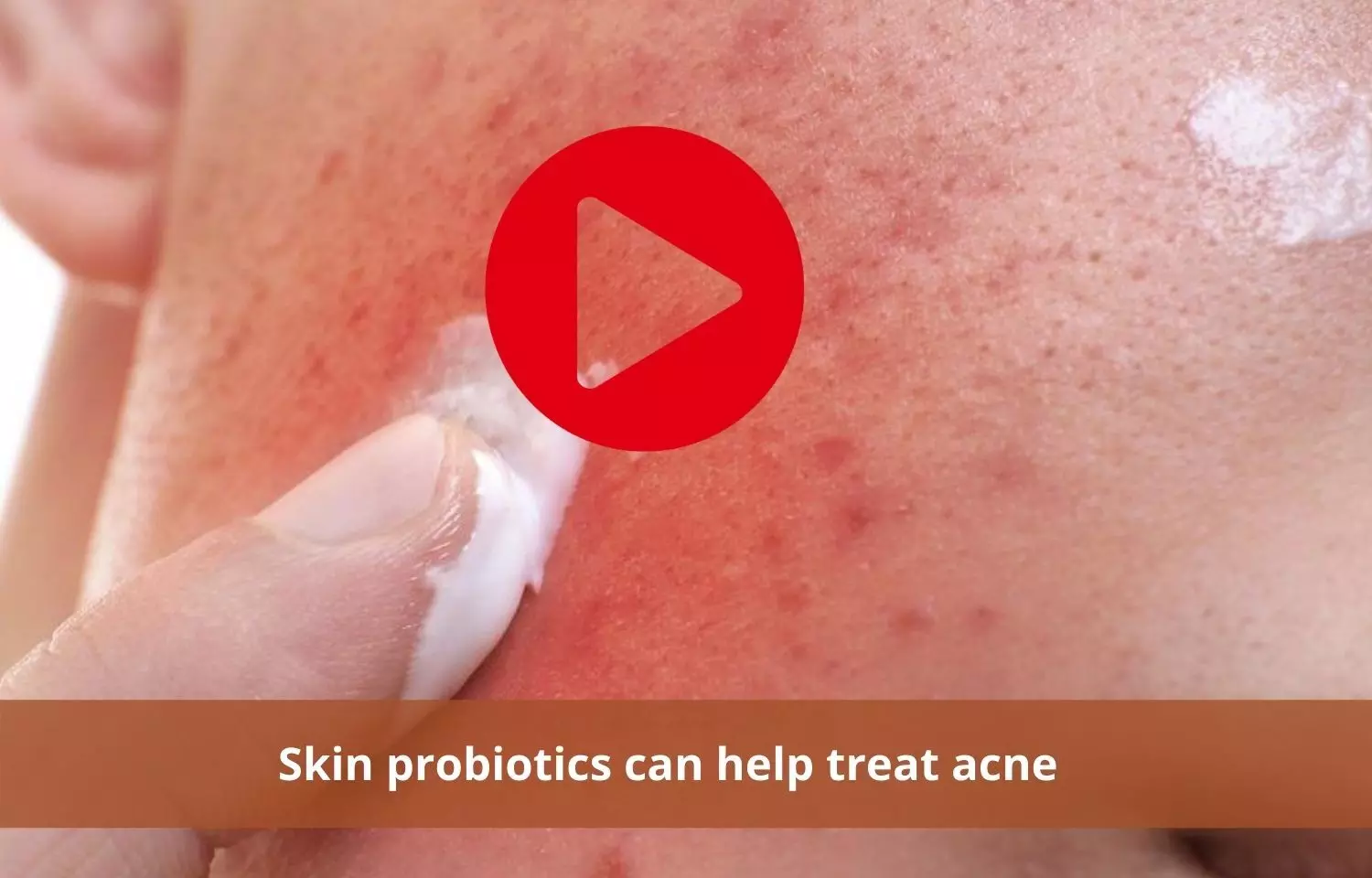 Skin probiotics effective in treating acne