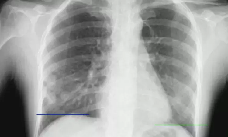 Dynamic chest radiography promising for assessment of diaphragm dysfunction: Study
