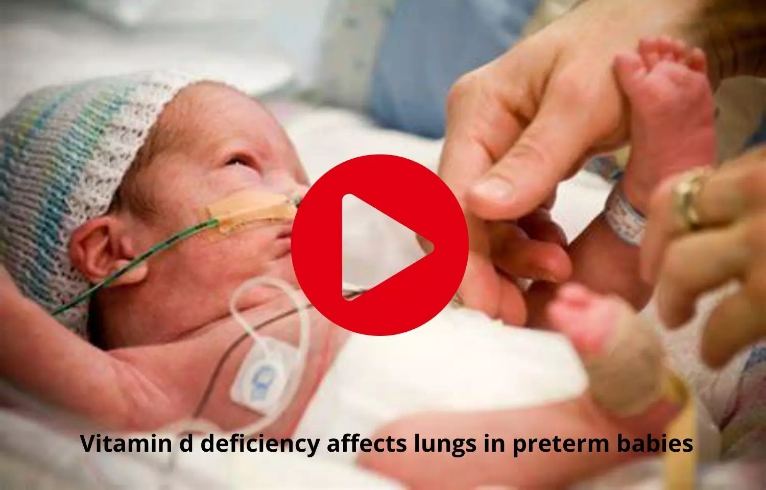 Vitamin d deficiency to affect lung deveopment in preterm babies