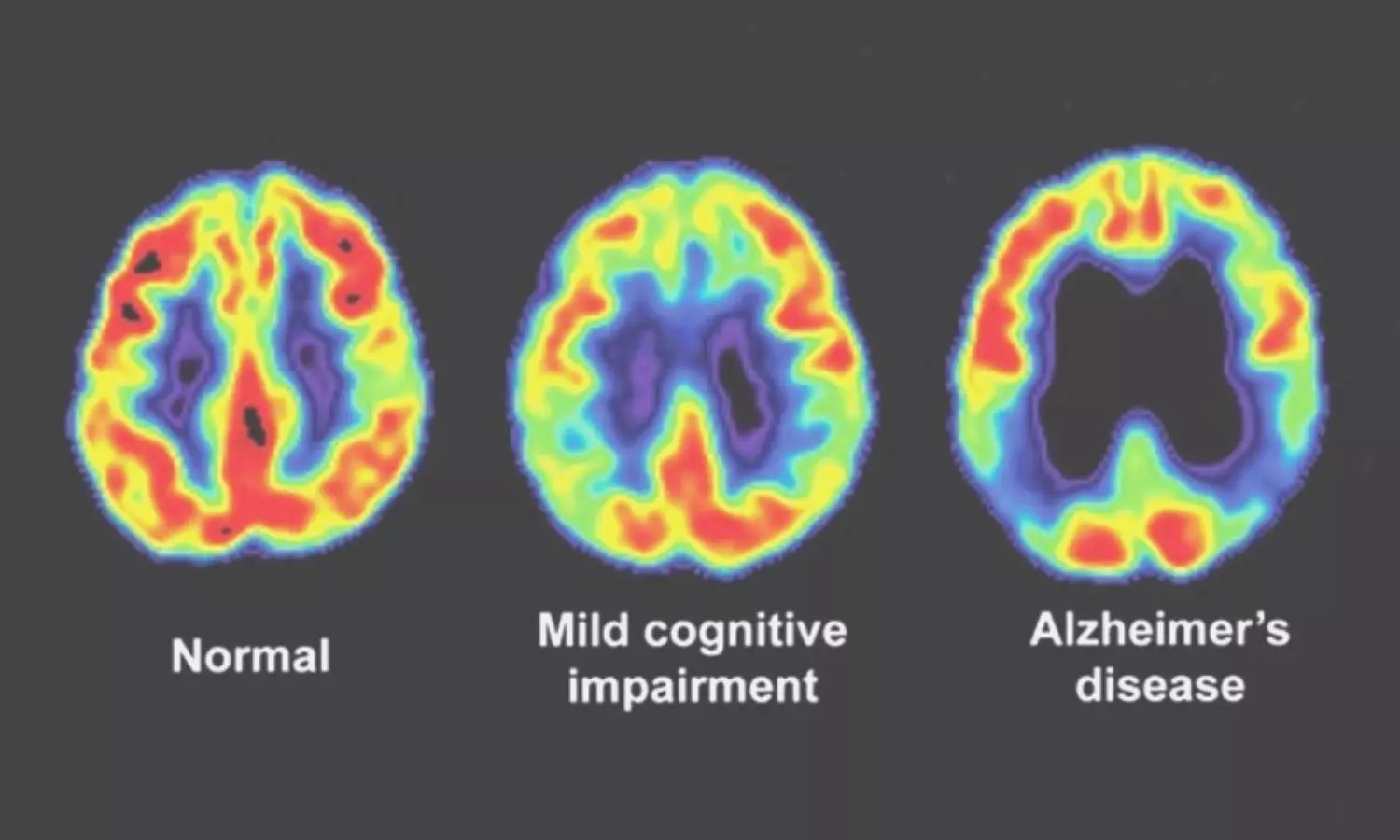Tau PET imaging can identify Alzheimers subtype associated with psychosis: Study