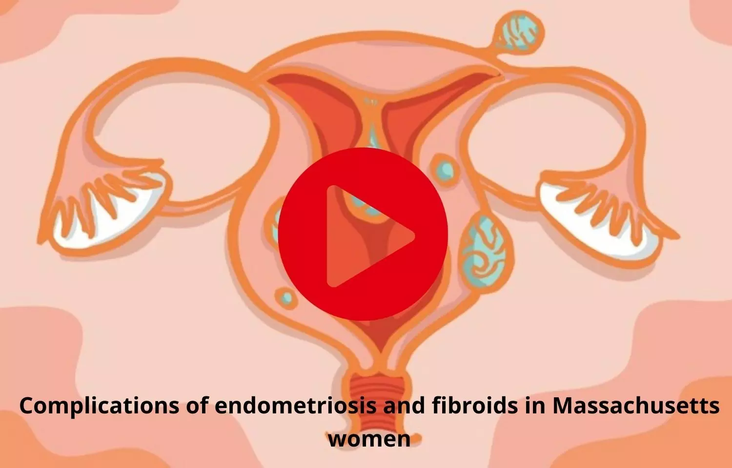 Complications of endometriosis and fibroids in Massachusetts women a concern