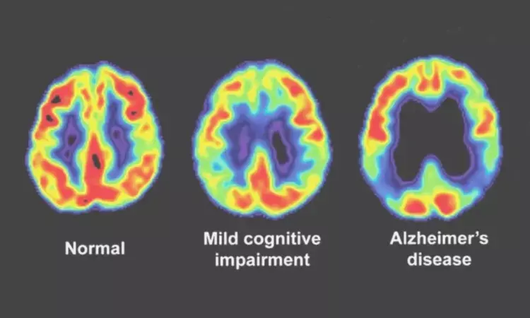 Tau PET imaging can identify Alzheimers subtype associated with psychosis: Study