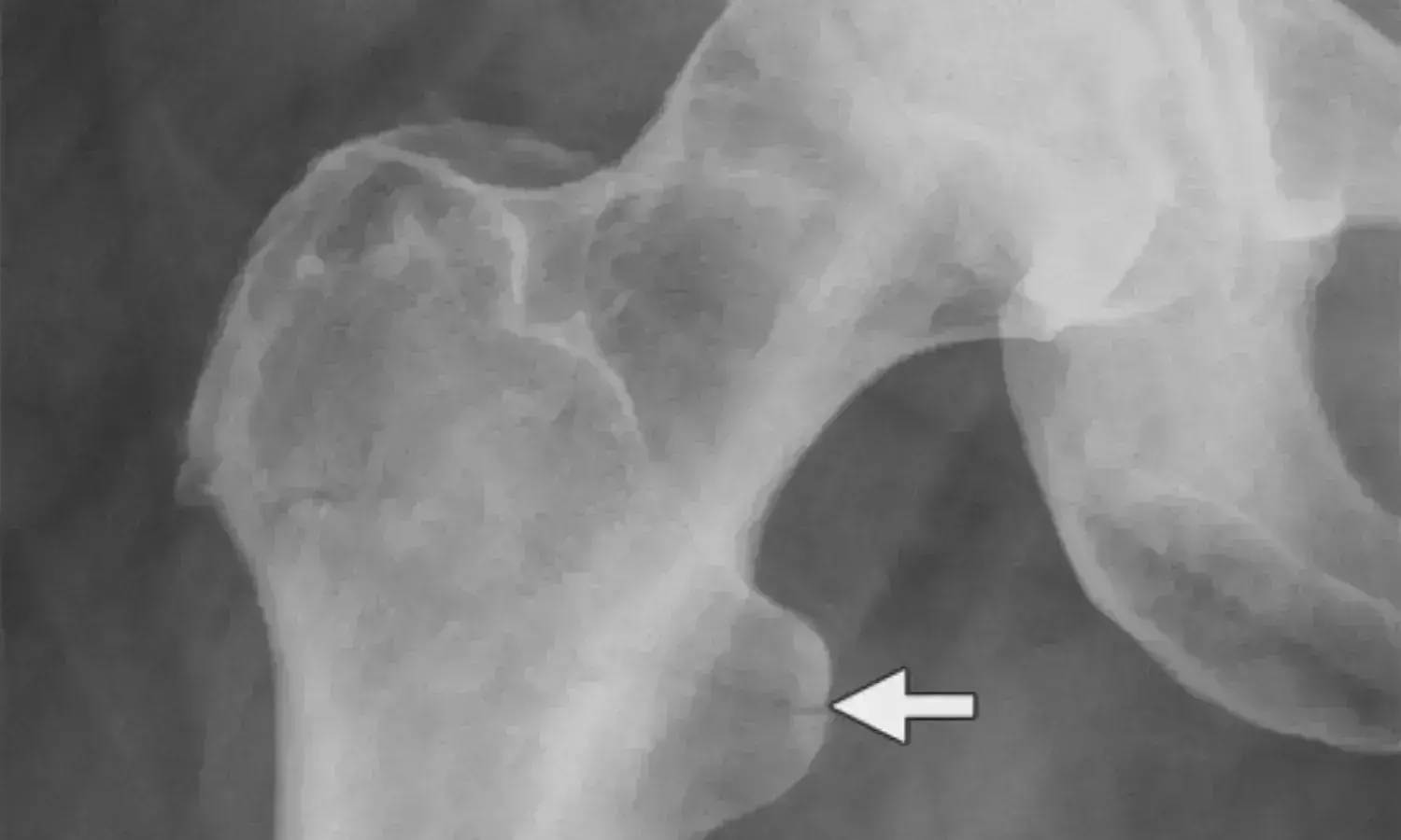 Nonoperative management viable option for proximal femoral fractures in frail patients