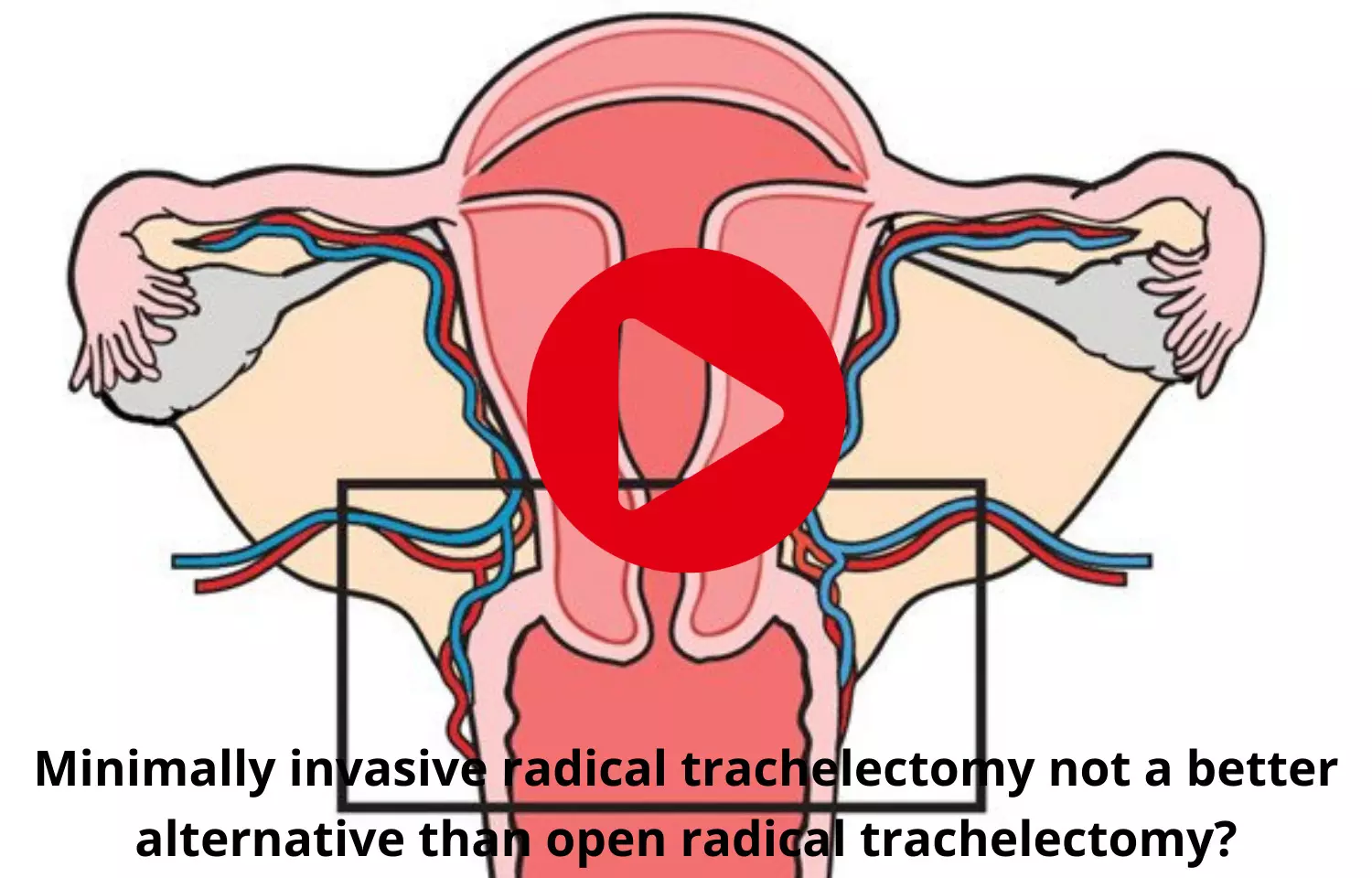 Minimally invasive radical trachelectomy not a good alternative for open radical trachelectomy?