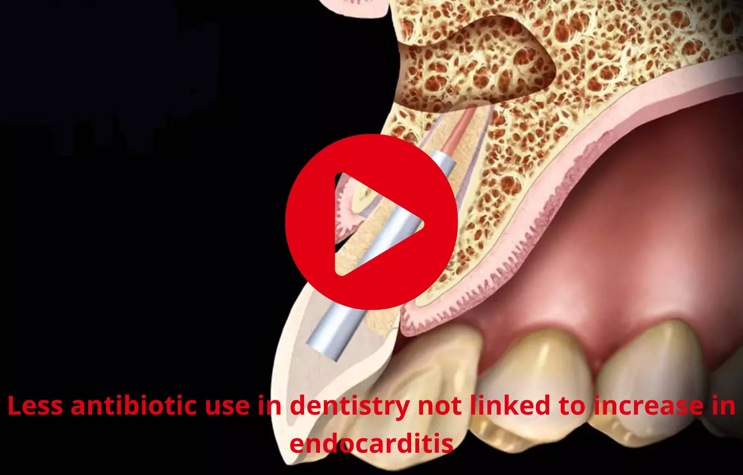 Lower Antibiotic use in dentistry not linked to increase in endocarditis