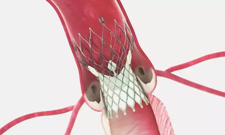 Self-Expanding TAVR performs well in cases of failed aortic bioprostheses: JACC