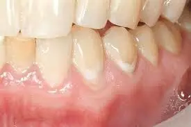 Varnishes containing 40% S-PRG filler effective for enamel caries remineralization: Study