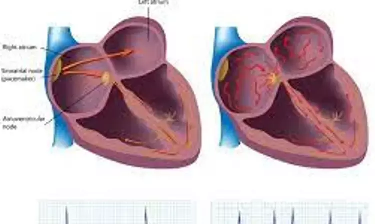 Anterior-lateral positioning of electrodes better for biphasic cardioversion of AF
