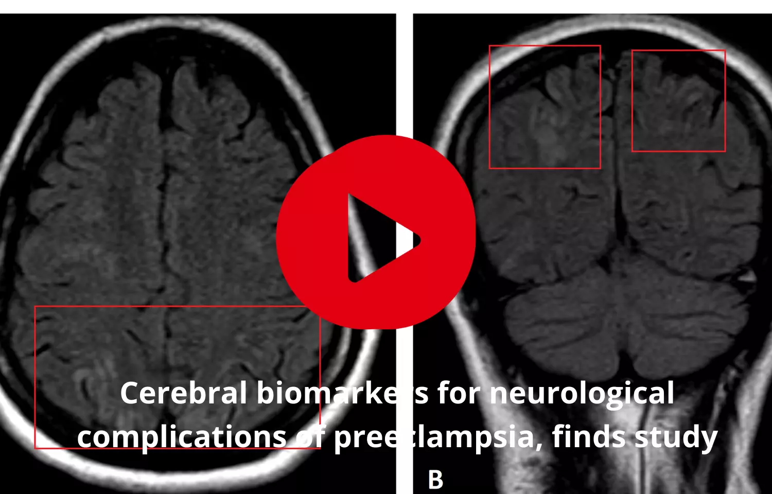 Cerebral biomarkers to find neurological complications of preeclampsia