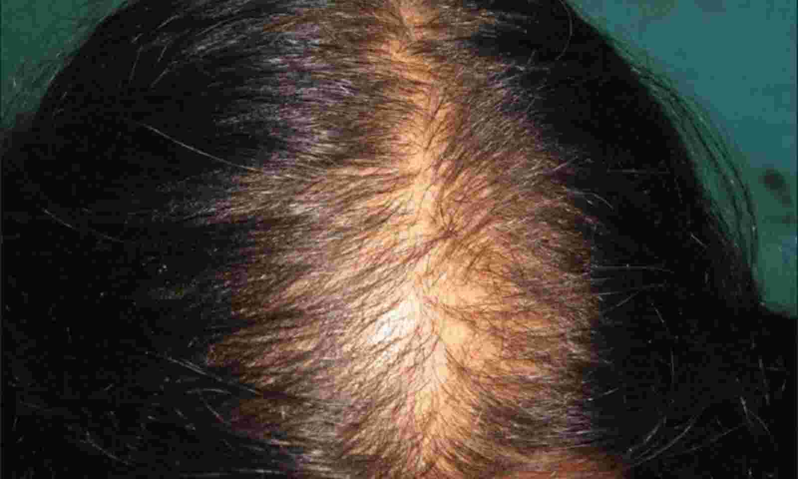 Towards a consensus on how to diagnose and quantify female pattern hair loss   The Female Pattern Hair Loss Severity Index FPHLSI  Harries  2016   Journal of the European Academy