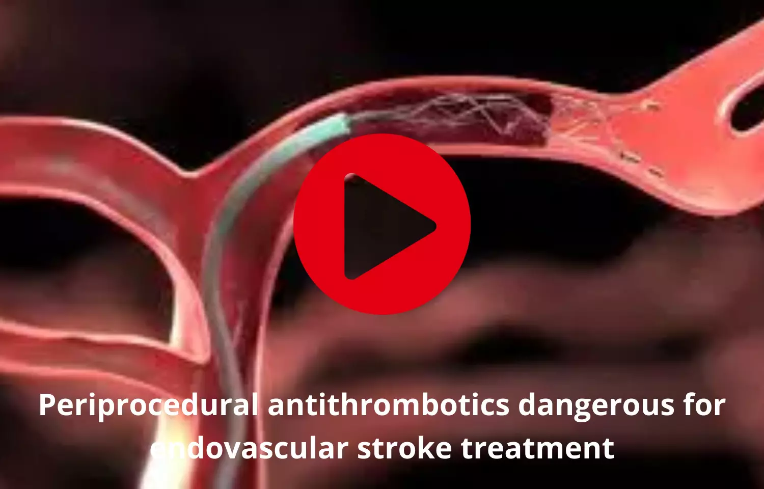 Periprocedural antithrombotics dangerous for endovascular stroke treatment