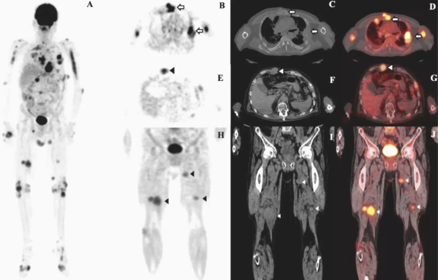 PET/CT helps assess early treatment response in multiple myeloma patients