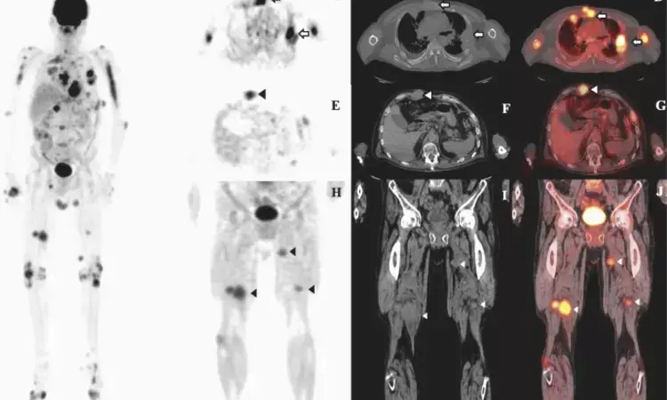 PET/CT helps assess early treatment response in multiple myeloma patients