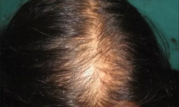 Female pattern hair loss prevalent in half of postmenopausal women