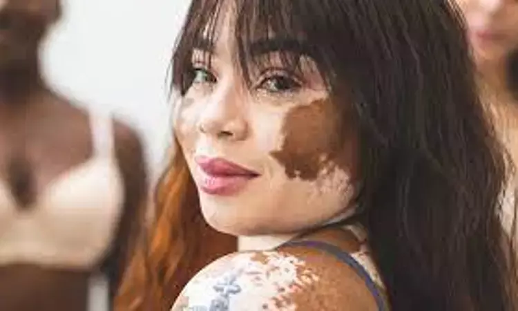 308-nm LED safe and effective treatment for vitiligo of face: Study