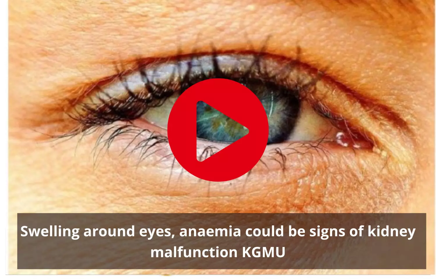 Swelling around eyes, anaemia could be signs of kidney malfunction KGMU