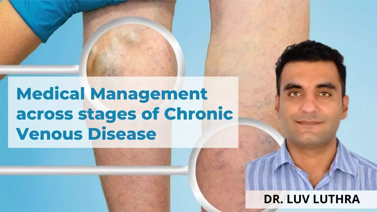 Understanding the Stages of Chronic Venous Insufficiency