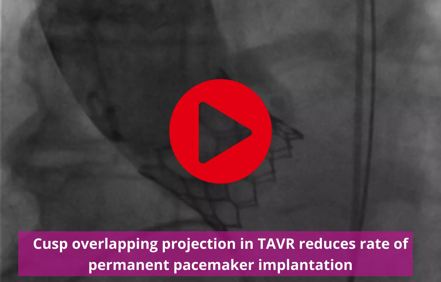 Cusp overlapping in TAVR reduces rate of permanent pacemaker implantation