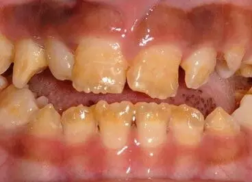 Use of glucocorticoids with NS tied with developmental abnormalities of teeth in kids