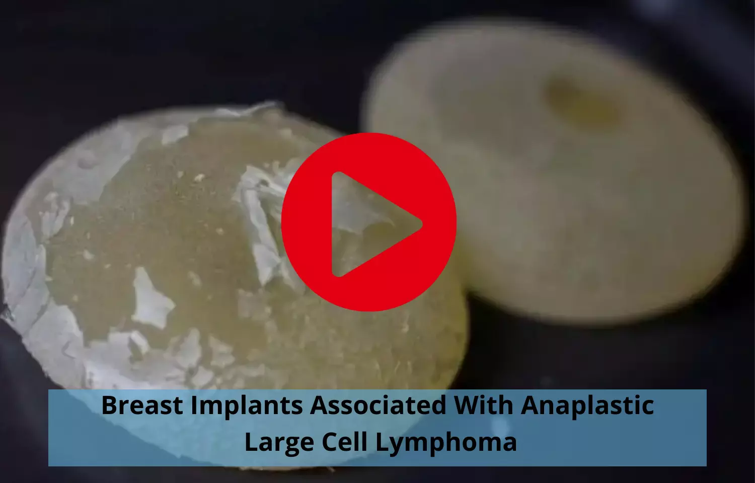 Breast Implants to cause Anaplastic Large Cell Lymphoma