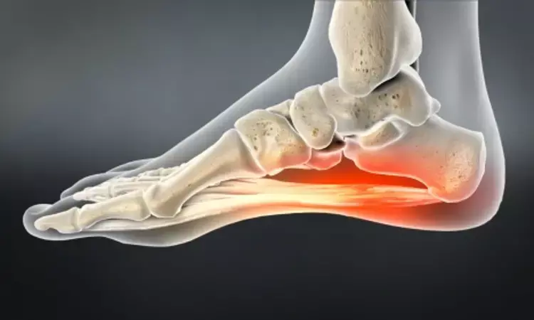 Radiofrequency microtenotomy for plantar fasciitis: A level II study