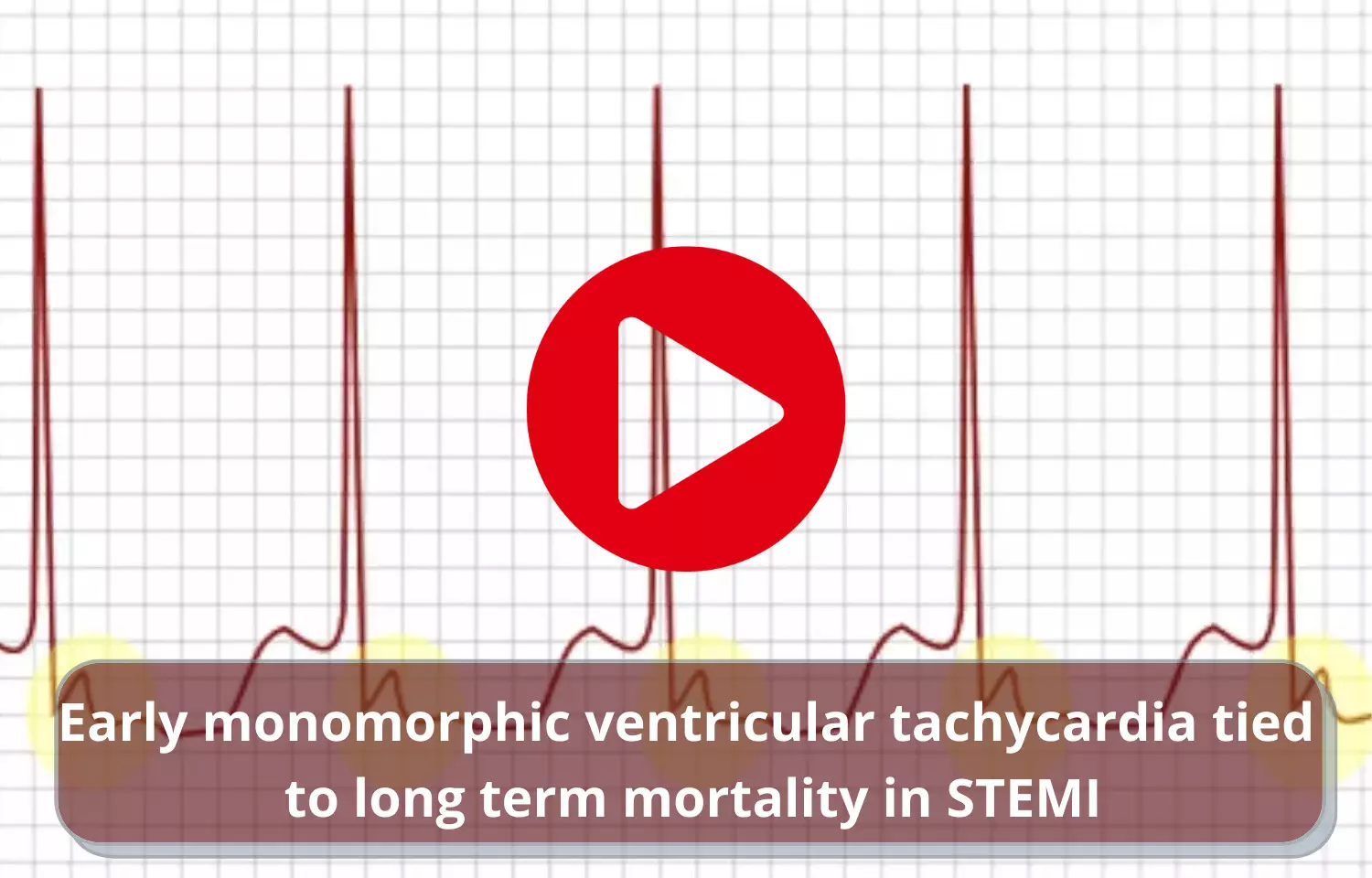 Early monomorphic ventricular tachycardia tied to long term mortality in STEMI