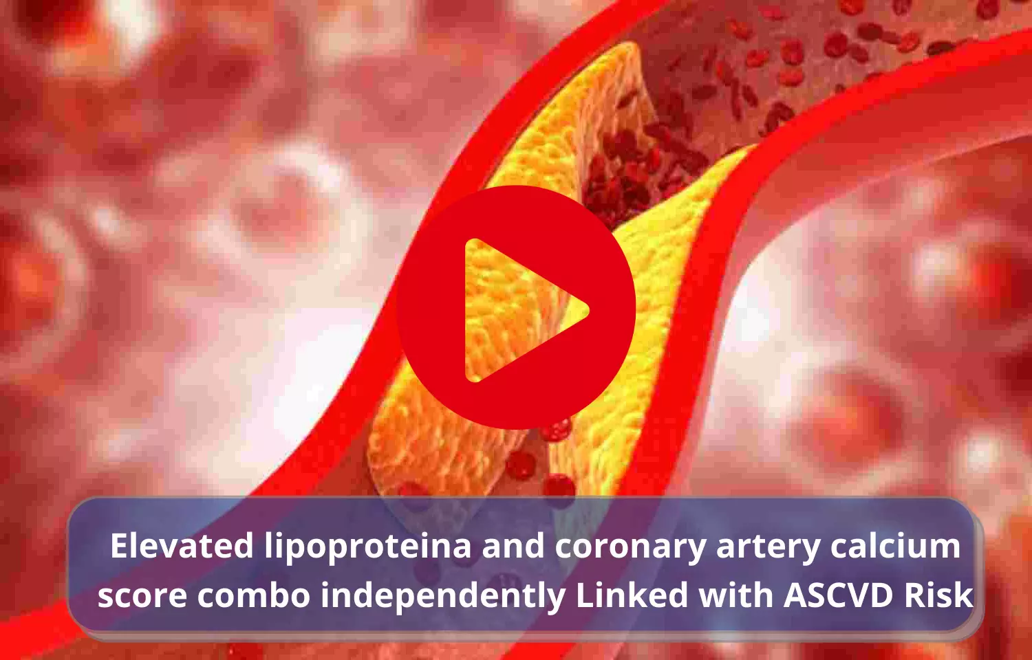 Elevated lipoproteins and coronary artery calcium score combo independently Linked with ASCVD Risk