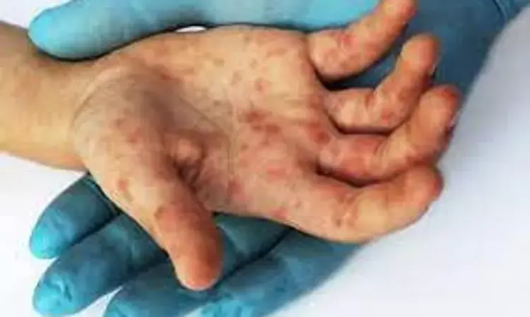Exposure to Epoxy Compounds can lead to Allergic-Contact Dermatitis, Eczema