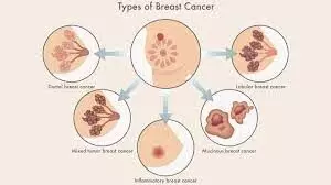 Adjuvant Olaparib in gBRCA+ Breast Cancer; decreases invasiveness and metastasis: study