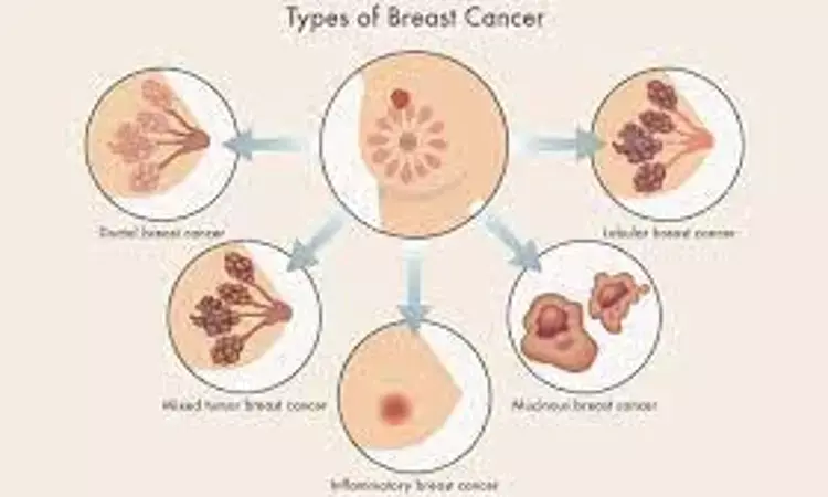 Adjuvant Olaparib in gBRCA+ Breast Cancer; decreases invasiveness and metastasis: study