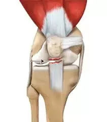 New Surgical Technique of Patellar Tendon Reconstruction in TKA